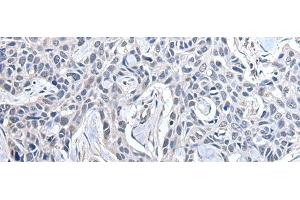 Immunohistochemistry of paraffin-embedded Human lung cancer tissue using PPIG Polyclonal Antibody at dilution of 1:50(x200) (PPIG anticorps)