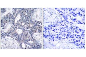 Immunohistochemical analysis of paraffin-embedded human breast carcinoma tissue, using Zap-70 (Ab-493) antibody (E021174). (ZAP70 anticorps)