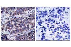 Immunohistochemical analysis of paraffin-embedded human breast carcinoma tissue, using p62Dok (phospho-Tyr362) antibody (E011276). (DOK1 anticorps  (pTyr362))