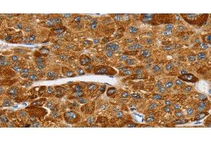 Immunohistochemistry of paraffin-embedded Human liver cancer tissue using SPARCL1 Polyclonal Antibody at dilution 1:30 (SPARCL1 anticorps)