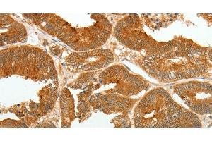 Immunohistochemistry of paraffin-embedded Human colon cancer tissue using ASCL1 Polyclonal Antibody at dilution 1:30 (ASCL1 anticorps)
