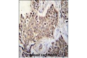 ZBTB42 Antibody (N-term) (ABIN655541 and ABIN2845052) immunohistochemistry analysis in formalin fixed and paraffin embedded human breast tissue followed by peroxidase conjugation of the secondary antibody and DAB staining. (ZBTB42 anticorps  (N-Term))
