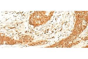 Immunohistochemistry of paraffin-embedded Human esophagus cancer tissue using HNF4A Polyclonal Antibody at dilution of 1:40(x200) (HNF4A anticorps)