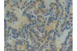 IHC-P analysis of Human Thyroid cancer Tissue, with DAB staining. (Apolipoprotein M anticorps  (AA 8-188))