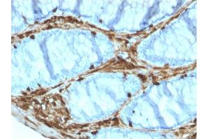 Formalin-fixed, paraffin-embedded human Colon Carcinoma stained with Annexin A1 Mouse Monoclonal Antibody (ANXA1/3566).