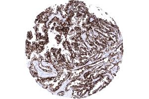 Strong membranous CD7 expression of an adenocarcinoma of the lung (Recombinant CD7 anticorps)
