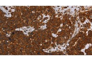 Immunohistochemistry of paraffin-embedded Human cervical cancer tissue using ERRFI1 Polyclonal Antibody at dilution 1:30 (ERRFI1 anticorps)