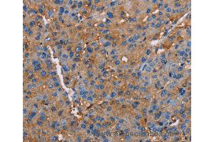 Immunohistochemistry of Human liver cancer using NLGN1 Polyclonal Antibody at dilution of 1:50 (Neuroligin 1 anticorps)