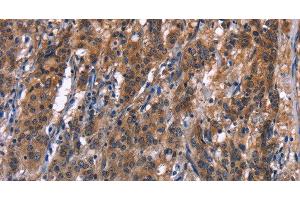 Immunohistochemistry of paraffin-embedded Human gastric cancer tissue using R3HCC1L Polyclonal Antibody at dilution 1:40 (GIDRP88 anticorps)