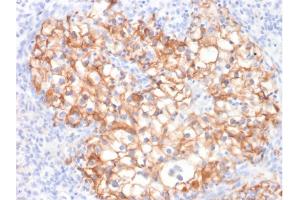 Formalin-fixed, paraffin-embedded human Renal Cell Carcinoma stained with CDH16-Monospecific Mouse Monoclonal Antibody (CDH16/2125). (Cadherin-16 anticorps  (AA 371-507))