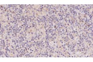 ABIN6273112 at 1/100 staining Human lymph cancer tissue by IHC-P. (DnaJ (Hsp40) Homolog, Subfamily B, Member 3 (DNAJB3) (Internal Region) anticorps)