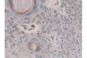 Detection of KIF18A in Human Skin cancer Tissue using Polyclonal Antibody to Kinesin Family, Member 18A (KIF18A)