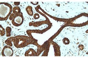Immunohistochemistry (IHC) image for anti-Cadherin 1, Type 1, E-Cadherin (Epithelial) (CDH1) (C-Term) antibody (ABIN7598898)