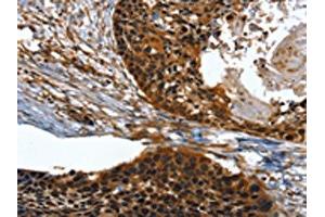 The image on the left is immunohistochemistry of paraffin-embedded Human esophagus cancer tissue using ABIN7131518(TWF1 Antibody) at dilution 1/30, on the right is treated with fusion protein. (TWF1 anticorps)