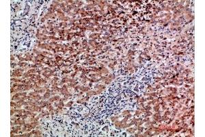 Immunohistochemical analysis of paraffin-embedded human-liver-cancer, antibody was diluted at 1:200. (GDF2 anticorps  (AA 371-420))
