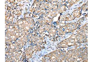 The image on the left is immunohistochemistry of paraffin-embedded Human breast cancer tissue using ABIN7128073(VAPA Antibody) at dilution 1/30, on the right is treated with fusion protein. (VAPA anticorps)