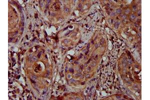 IHC image of ABIN7159706 diluted at 1:300 and staining in paraffin-embedded human cervical cancer performed on a Leica BondTM system.