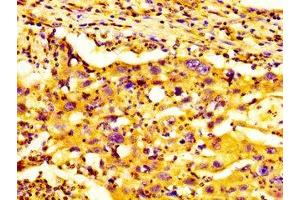 IHC image of ABIN7154550 diluted at 1:300 and staining in paraffin-embedded human lung cancer performed on a Leica BondTM system.