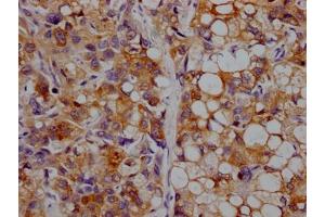 IHC image of ABIN7127343 diluted at 1:100 and staining in paraffin-embedded human liver cancer performed on a Leica BondTM system. (Recombinant APOC3 anticorps)