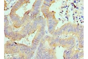Immunohistochemistry of paraffin-embedded human colon cancer using ABIN7143994 at dilution of 1:100 (AIMP1 anticorps  (AA 25-180))