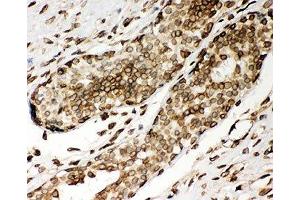 IHC-P: Lamin A antibody testing of human breast cancer tissue (Lamin A/C anticorps  (AA 481-646))