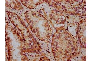 IHC image of ABIN7152686 diluted at 1:400 and staining in paraffin-embedded human prostate cancer performed on a Leica BondTM system. (FRMD7 anticorps  (AA 464-617))