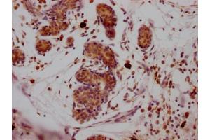 IHC image of ABIN7127832 diluted at 1:100 and staining in paraffin-embedded human breast cancer performed on a Leica BondTM system.