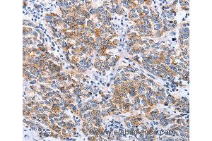 Immunohistochemistry of Human breast cancer using CLDN3 Polyclonal Antibody at dilution of 1:25