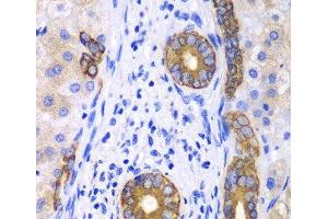 Immunohistochemistry of paraffin-embedded Human liver cancer using KRT19 Polyclonal Antibody at dilution of 1:100 (40x lens).
