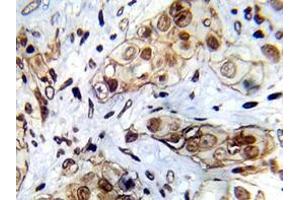 Immunohistochemistry analyzes of Abl1 antibody in paraffin-embedded human breast carcinoma tissue. (ABL1 anticorps)