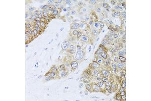 Immunohistochemistry of paraffin-embedded human lung cancer using CHD1 antibody. (CHD1 anticorps)