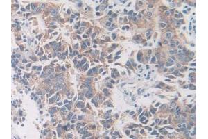 Detection of NCCT in Human Prostate cancer Tissue using Polyclonal Antibody to Na-Cl Cotransporter (NCCT)