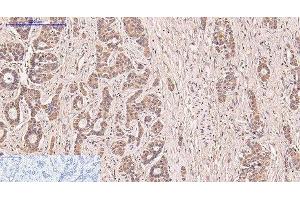 Immunohistochemistry of paraffin-embedded Human liver cancer tissue using CD5 Monoclonal Antibody at dilution of 1:200.
