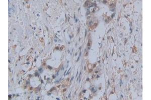 DAB staining on IHC-P; Samples: Human Pancreatic cancer Tissue (CCL2 anticorps  (AA 24-99))