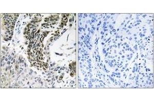 Immunohistochemistry analysis of paraffin-embedded human lung carcinoma tissue, using RREB1 Antibody.