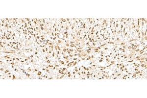 Immunohistochemistry of paraffin-embedded Human liver cancer tissue using GTF2A2 Polyclonal Antibody at dilution of 1:30(x200)