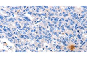 Immunohistochemistry of paraffin-embedded Human ovarian cancer tissue using GRIN2D Polyclonal Antibody at dilution 1:30 (GRIN2D anticorps)