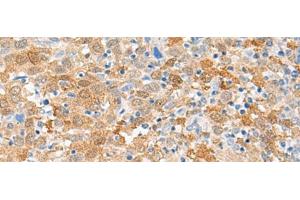 Immunohistochemistry of paraffin-embedded Human cervical cancer tissue using FANCB Polyclonal Antibody at dilution of 1:60(x200)