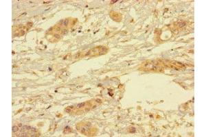 Immunohistochemistry of paraffin-embedded human pancreatic cancer using ABIN7166350 at dilution of 1:100 (YIPF6 anticorps  (AA 2-84))