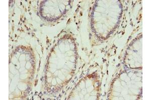 Immunohistochemistry of paraffin-embedded human colon cancer using ABIN7142648 at dilution of 1:100 (NSUN4 anticorps  (AA 26-284))
