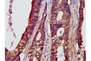 IHC image of ABIN7161781 diluted at 1:500 and staining in paraffin-embedded human colon cancer performed on a Leica BondTM system.
