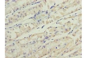 Immunohistochemistry of paraffin-embedded human gastric cancer using ABIN7173199 at dilution of 1:100 (TMEM31 anticorps  (AA 1-118))