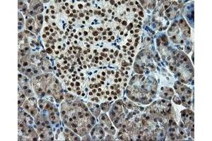 Immunohistochemical staining of paraffin-embedded Adenocarcinoma of colon tissue using anti-RC211175 mouse monoclonal antibody. (TUBA8 anticorps)