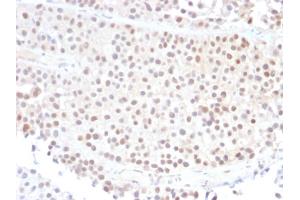 Formalin-fixed, paraffin-embedded human Bladder Carcinoma stained with p21 Mouse Monoclonal Antibody (DCS-60. (p21 anticorps)