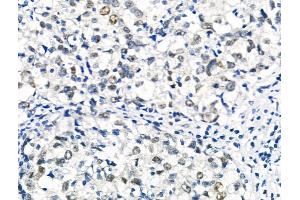 Phospho-RAD18 (Ser99) Antibody at 1/100 staining Human breast cancer by IHC-P. (RAD18 anticorps  (pSer99))