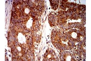 Immunohistochemical analysis of paraffin-embedded rectum cancer tissues using EIF5 mouse mAb with DAB staining.