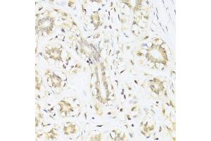 Immunohistochemistry of paraffin-embedded human mammary cancer using STAT1 antibody.