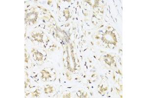 Immunohistochemistry of paraffin-embedded human mammary cancer using STAT1 antibody. (STAT1 anticorps  (AA 650-750))