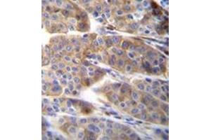 Immunohistochemistry analysis in formalin fixed and paraffin embedded human melanoma reacted with PLA2G2C Antibody (C-term) followed which was peroxidase conjugated to the secondary antibody and followed by DAB staining. (PLA2G2C anticorps  (C-Term))