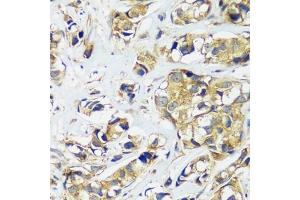 Immunohistochemistry of paraffin-embedded human breast cancer using CCDC124 antibody  at dilution of 1:100 (40x lens). (CCDC124 anticorps  (AA 1-223))